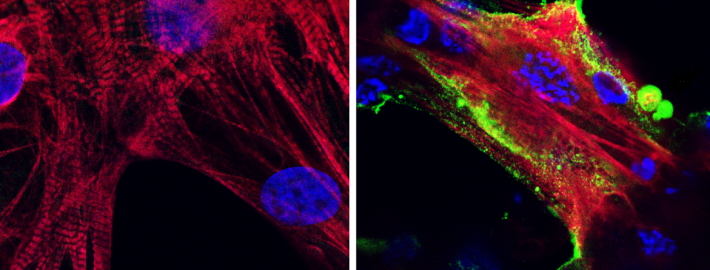 Covid in heart muscle: Microscope images showing (left) healthy heart muscle cells and (right) heart muscle cells that have been infected and damaged by the SARS-CoV-2 virus (in green). Credit: UCLA Broad Stem Cell Research Center/JCI Insight